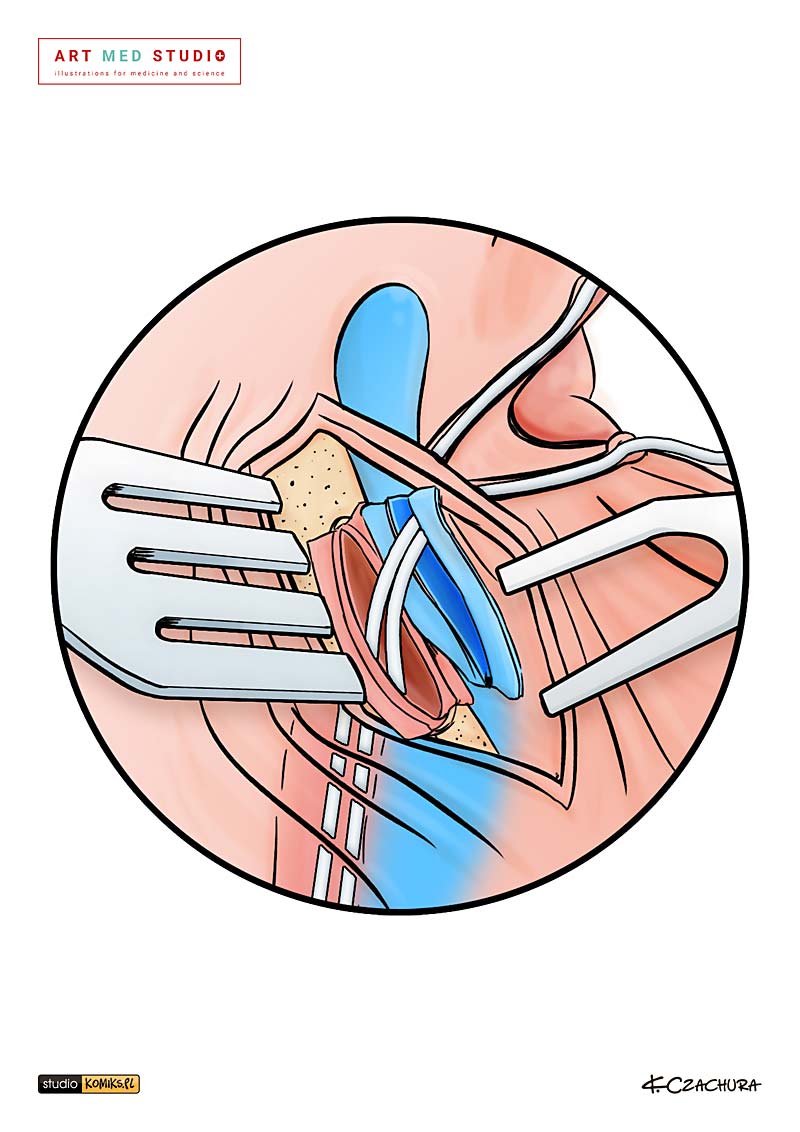 medical illustration designed by artmedstudio.com