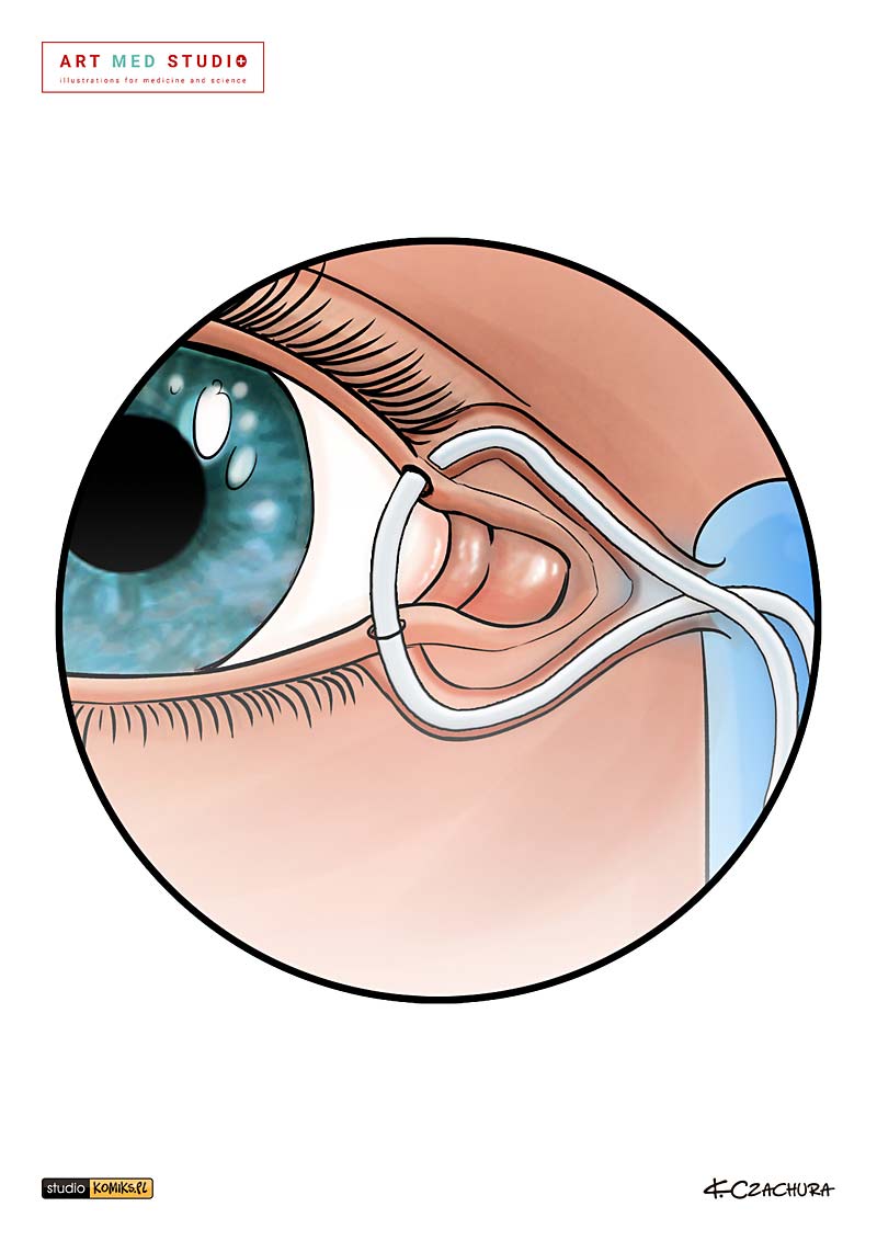 medical illustration designed by artmedstudio.com