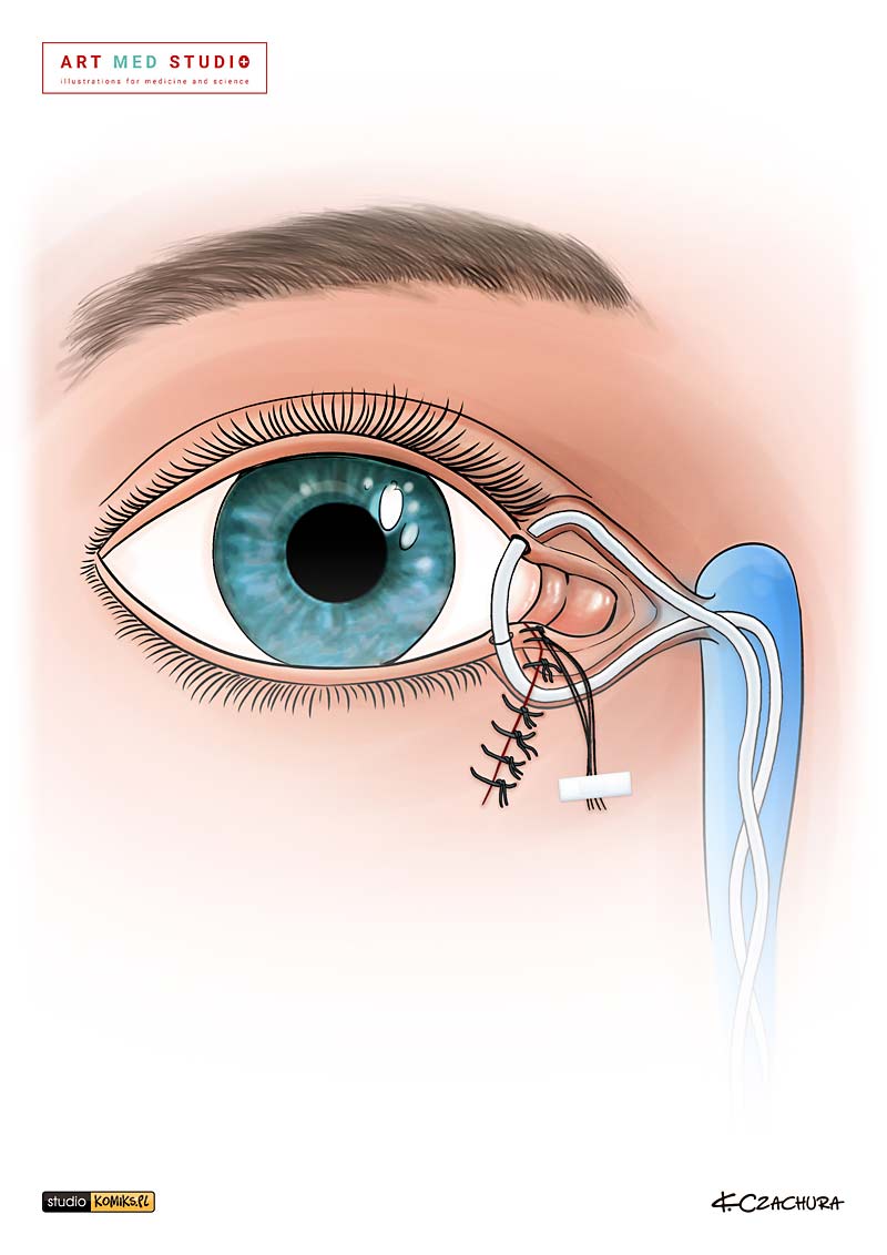 medical illustration designed by artmedstudio.com