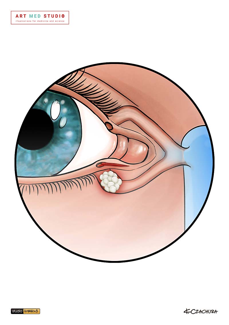 medical illustration designed by artmedstudio.com